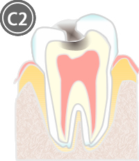 虫歯C2