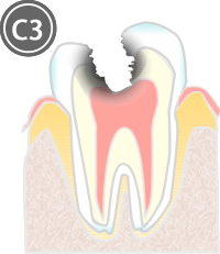 虫歯C3