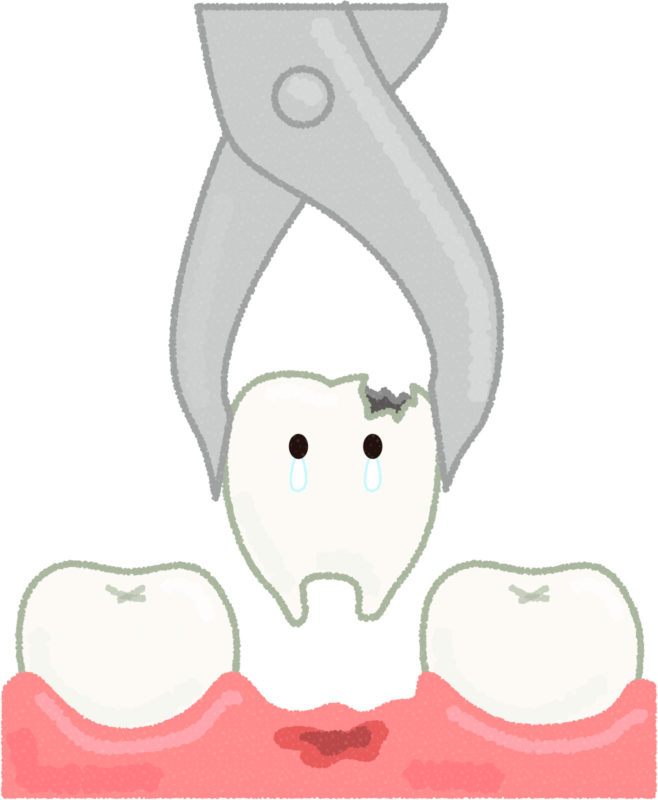 C4の虫歯治療