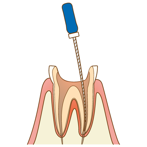 根管治療
